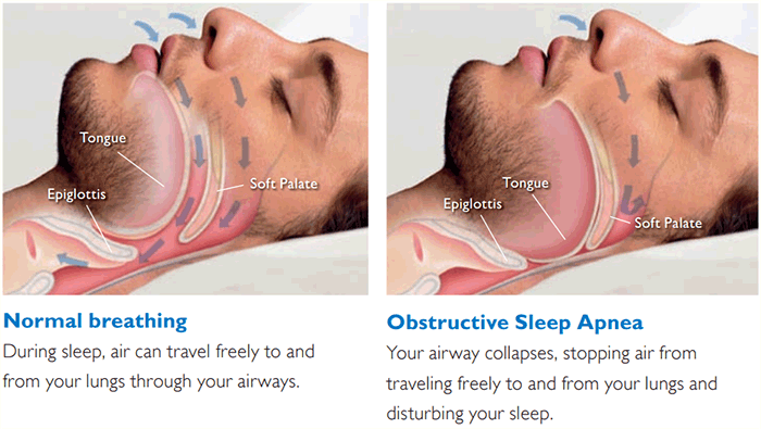 Qu'est-ce que l'apnée obstructive du sommeil (AOS) ?